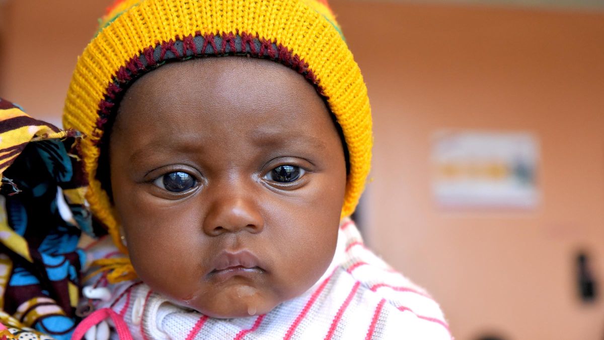 Baby mit einem stark vergrößerten Auge