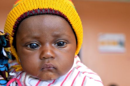 Baby mit einem stark vergrößerten Auge