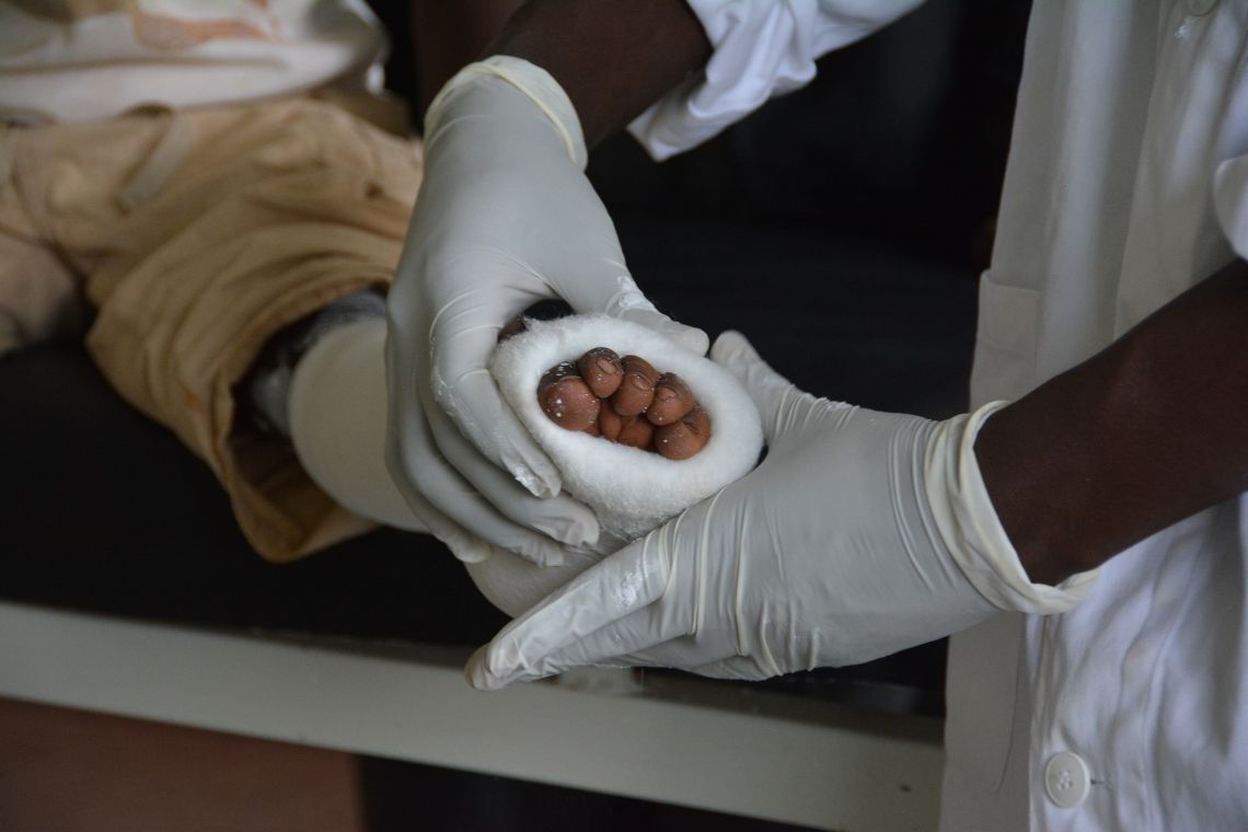 Zehen schauen aus einem Gips; zwei Hände in Handschuhen umfassen den eingegipsten Fuß