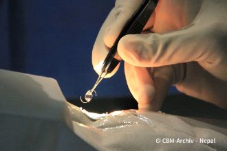 Thema Graue-Star-Operation in Deutschland: Eine Hand in Hygienehandschuhen hält eine Pinzette mit einer klaren Kunsstofflinse, die zwei runde Metallhaken hat.