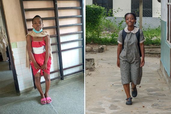 Mädchen mit O-Beinen vor einer Sprossenwand, zweites Bild mit einem Mädchen in Schuluniform. Es trägt einen Rucksack und hat gerade Beine.