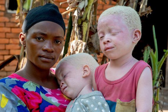 Afrikanische Frau mit zwei kleinen, hellhäutigen Kindern mit Albinismus.