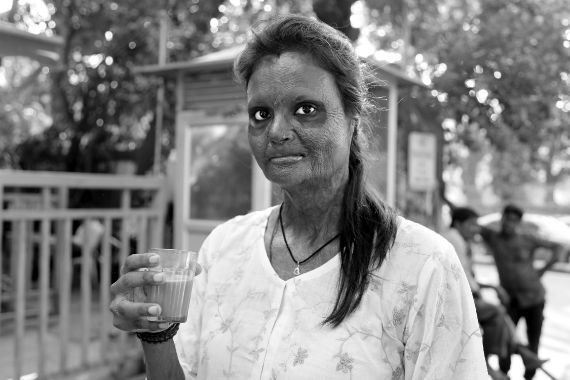 Eine Frau mit vernarbtem Gesicht, Hals und Händern steht mit einem Trinkglas in der Hand im Freien.