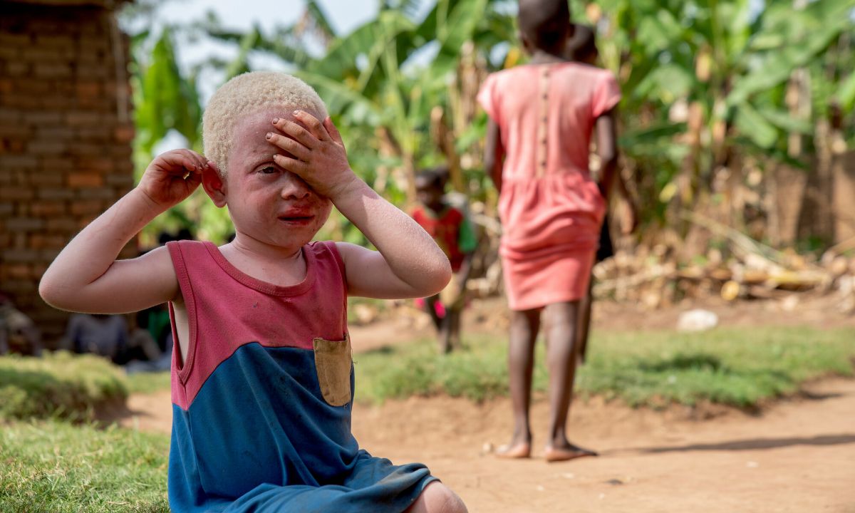 Ein kleines, hellhäutiges, blondes afrikanisches Mädchen mit Albinismus hat die linke Hand aufs linke Auge gelegt.